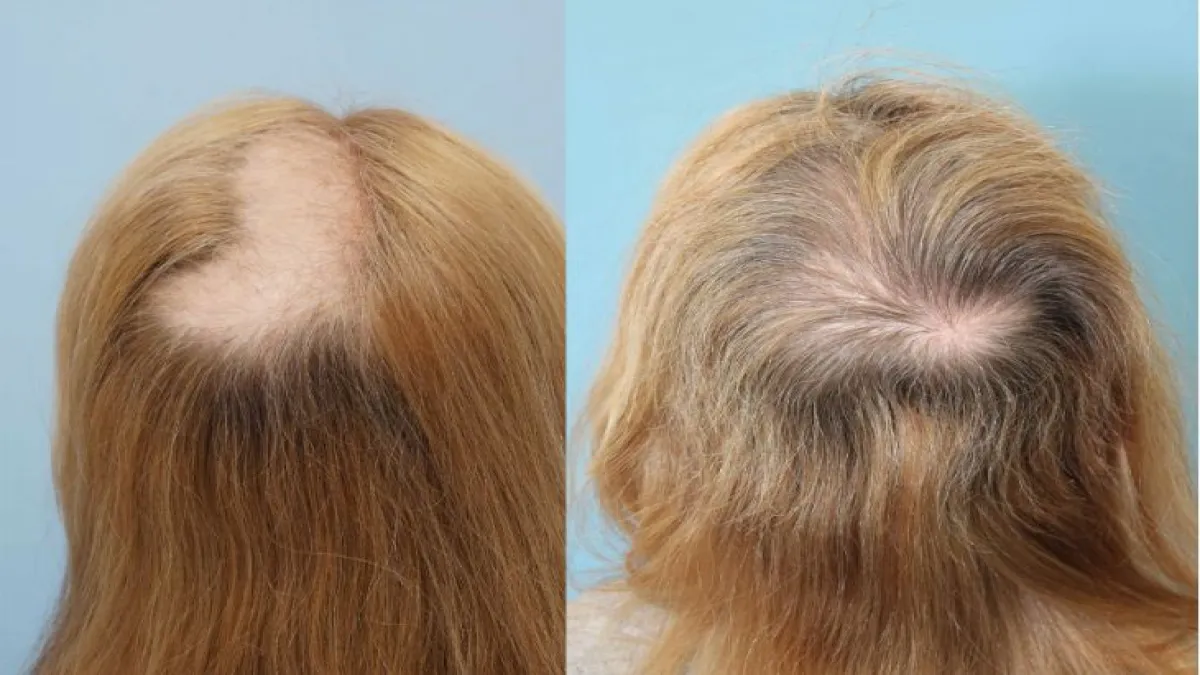 درمان ريزش مو